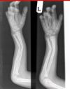 Green-stick fracture of Radius & Ulna