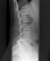 L3/4 lumbar Disciitis. Lateral radiograph. Courtesy of www.healthengine.com.au