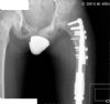 AP pelvis showing reconstruction of peri-prosthetic fracture of non-invasive growing femoral replacement with plate, cables and fibula strut graft.

History: 9 yr male with osteosarcoma of distal femur.