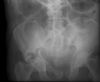 Pelvic fracture. Radiograph. Courtesy of www.healthengine.com.au