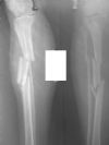 Segmental Tibia Fracture