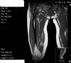 MRI - intertrochanteric liposarcoma