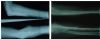 Radial head Dx + Comminuted Ulna Fx
(before and after operation)
