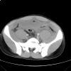 Lateral compression pelvic fracture. CT. Courtesy of Dushan Atkinson