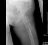 Oblique Subtrochanteric Femur Fracture