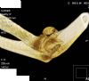 Distal humerus intra-articular fracture with large capitellar fragment and radial head fracture. CT 3D reconstruction 5