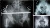 Fixation of pelvic fracture with External fixator+ plate(for Ilium) and Intramedulary nailing for femoral fracture