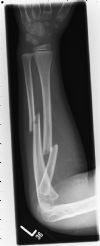 displaced fracture of the left radius at the junction of the proximal and middle thirds. There is an associated displaced fracture of the mid third of the left ulnar 