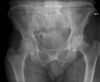 Pelvic synostosis. Radiograph. Courtesy of www.healthengine.com.au