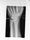 Trans Scaphoid Perilunate Dislocation - AP View