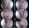 Arthroscopic capsular plication