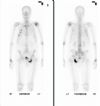 Bone scan showing metastatic lesion in the inferior pubic ramus. Patient  known to have prostatic Ca.