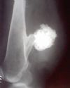 Osteochondroma lower end femur