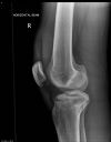 Tibial plateau fracture. Variant of Schatzker 5. Courtesy of www.healthengine.com.au