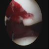 Patella osteochondral fracture post dislocation