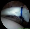 SLAP type 4 tear of shoulder as seen from posterior portal repaired - 3/3