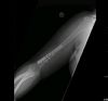 ORIF of distal humeral fracture through posterior approach