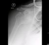 Anterior fracture dislocation of the right shoulder