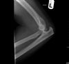 Posterior fracture dislocation of elbow. Lateral radiograph