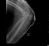 Post reduction elbow dislocation. This patient had the terrible triad