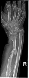 Pseudo-arthrosis Radial diaphseal fracture