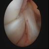 Displaced bucket handle tear lateral meniscus