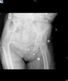 Hip Joint Ankylosis AP view - 50 Years post TB of the joint