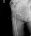 Hip Joint Ankylosis - Axial view - 50 years post TB infection of the joint.
The patient is fully active!