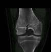 15 y old, MVA, MFC 3 SH III
CT scan - Coronal slice