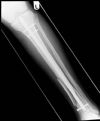 AP Radiograph - Expert Tibial Nail through a distal tibial fracture