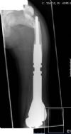 AP left femur showing peri-prosthetic fracture of non-invasive growing femoral replacement.

History: 9 yr male with osteosarcoma of distal femur.