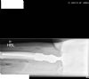lateral radiograph - right proximal femoral replacement