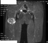 MRI showing osteochondroma posterior aspect of right proximal femur