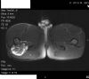 MRI - oseochondroma posterior aspect of right proximal femur