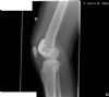 lateral radigraph - AVON patello-femoral joint replacement