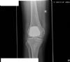 AP radiograph showing AVON patello-femoral joint replacement