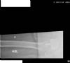 lateral radiograph - Biomet re-surfacing right hip