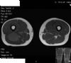 MRI - intra-muscular soft tissue sarcoma posterior right thigh
