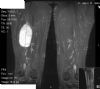 MRI - intramuscular soft tissue sarcoma right posterior thigh