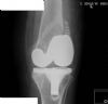 AP of Knee peri-prosthetic fracture - clearly seen with oblique fracture

History : 70 yr female, underwent PFC total knee replacement, then subsequent non-traumatic fracture 11 days post op
