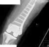 AP of Knee after fixation of peri-prosthetic fracture with 13 hole PERILOC plate and locking screws

History : 70 yr female, underwent PFC total knee replacement, then subsequent non-traumatic fracture 11 days post op
