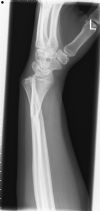 Lateral Wrist Radiograph - # Left Radial Metaphysis and dislocation of the ulnar