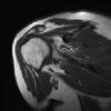 MRI Shoulder - T1W - Coronal Oblique - ACJ Degenerative Joint Disease