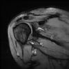 MRI Shoulder - T2W - Coronal Oblique - ACJ Degenerative Joint Disease