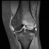 MRI Knee - PD - Fat Saturated - Coronal - Bone Marrow Oedema