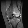 MRI Knee - STIR - Coronal - Bone Marrow Oedema