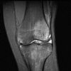 MRI Knee - STIR - Coronal - Bone Marrow Oedema 00