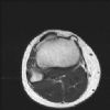 MRI Knee - T2W - Axial - Simple Tibial Osteochondroma 00