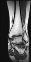 MRI Ankle - T1W - Coronal -Osteochondral defect-superior medial aspect of the talar dome 01