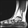 MRI Ankle - T1W - Sagittal -Osteochondral defect-superior medial aspect of the talar dome